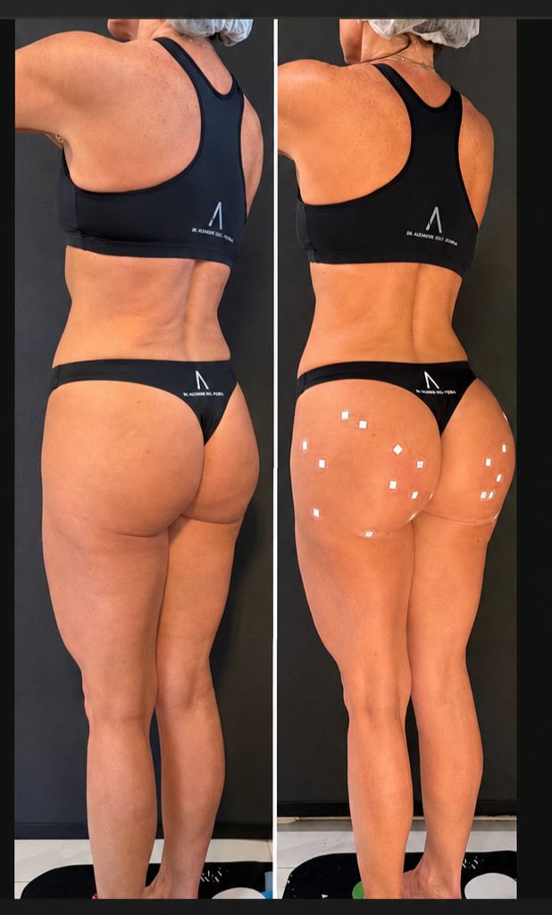 Antes e depois — Bioplastia Glútea Corretiva — Dr. Alexandre Dell'Aquila