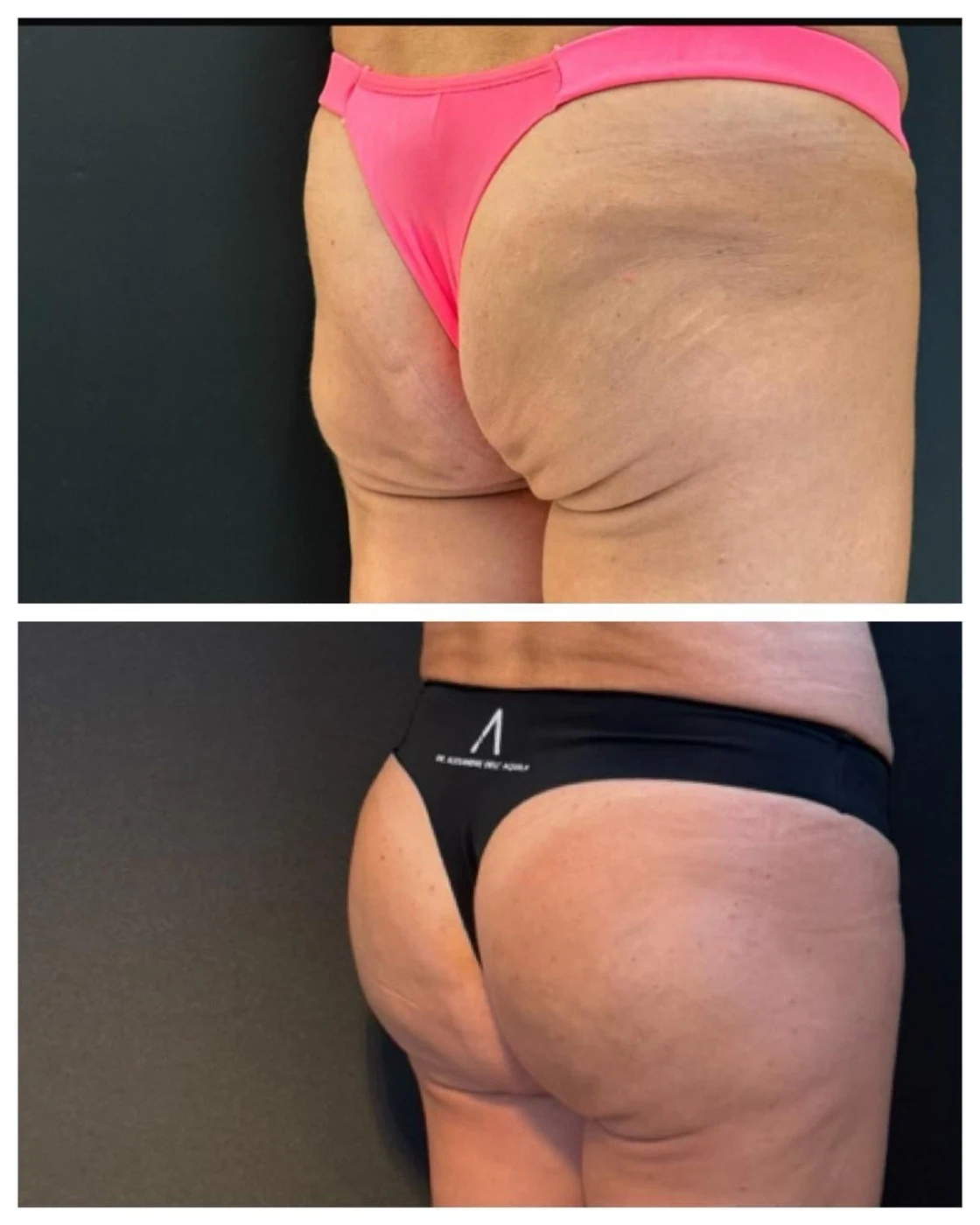 Antes e depois — Bioplastia Glútea Corretiva — Dr. Alexandre Dell'Aquila