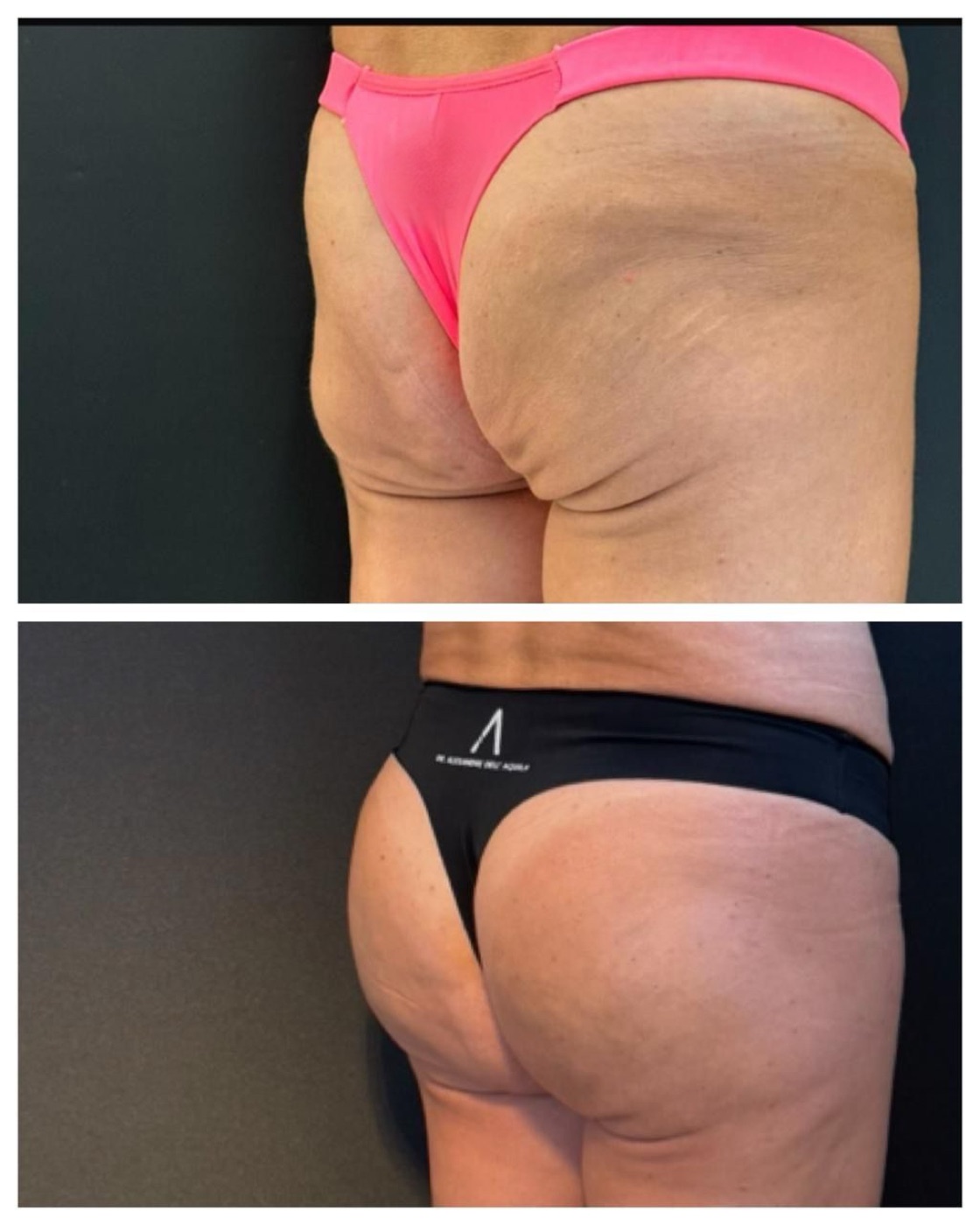 Antes e depois — Bioplastia Glútea Corretiva — Dr. Alexandre Dell'Aquila