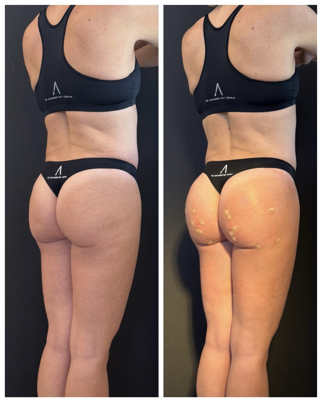 Antes e depois — Bioplastia Glútea Corretiva — Dr. Alexandre Dell'Aquila