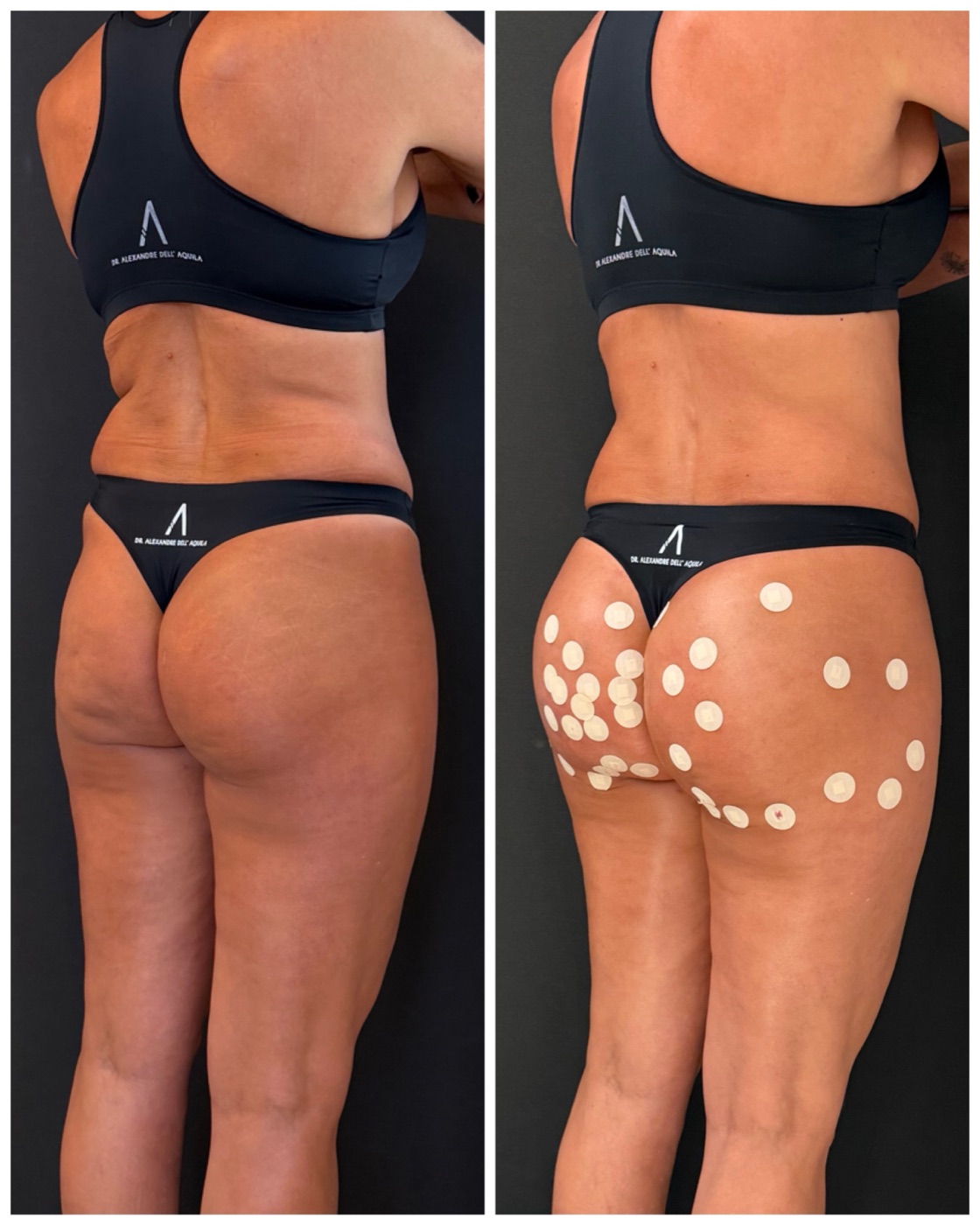 Antes e depois — Bioplastia Glútea Corretiva — Dr. Alexandre Dell'Aquila