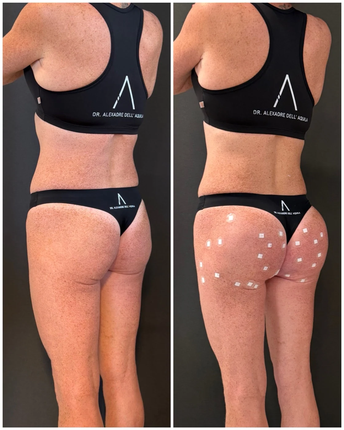 Antes e depois — Bioplastia Glútea Corretiva — Dr. Alexandre Dell'Aquila