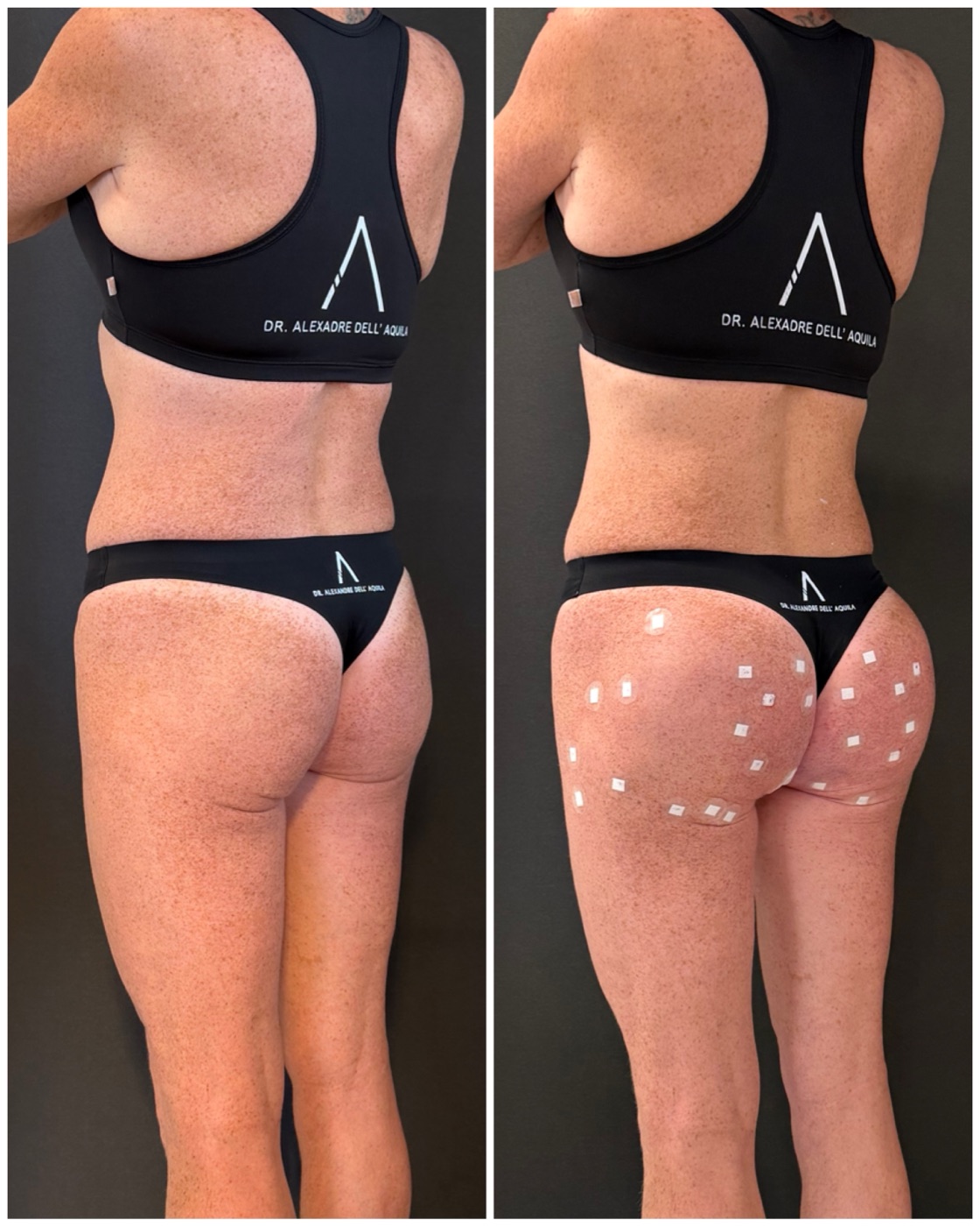 Antes e depois — Bioplastia Glútea Corretiva — Dr. Alexandre Dell'Aquila