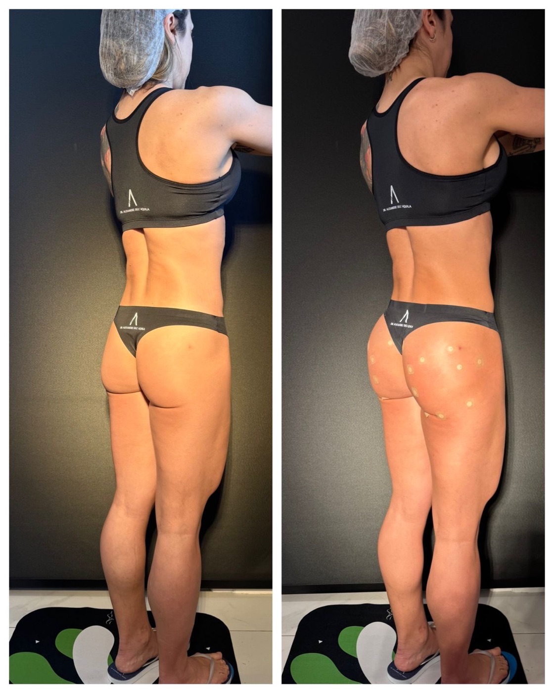 Antes e depois — Bioplastia Glútea Corretiva — Dr. Alexandre Dell'Aquila