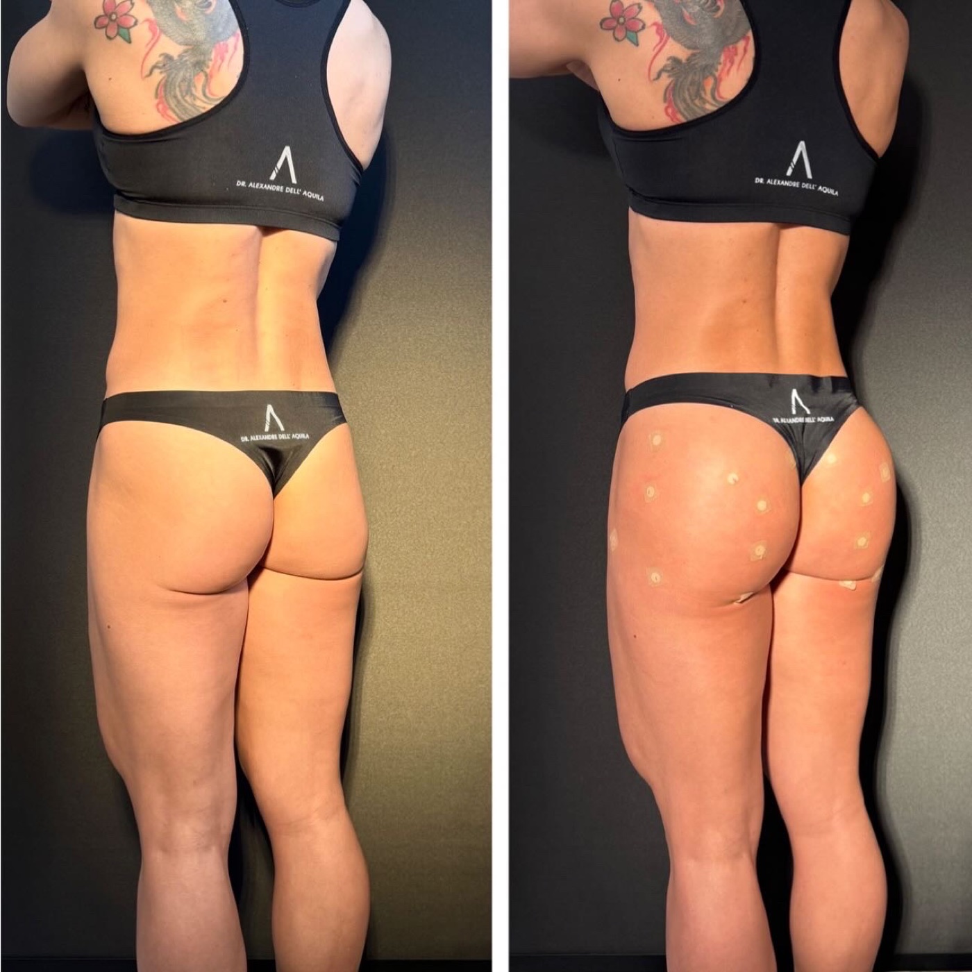 Antes e depois — Bioplastia Glútea Corretiva — Dr. Alexandre Dell'Aquila