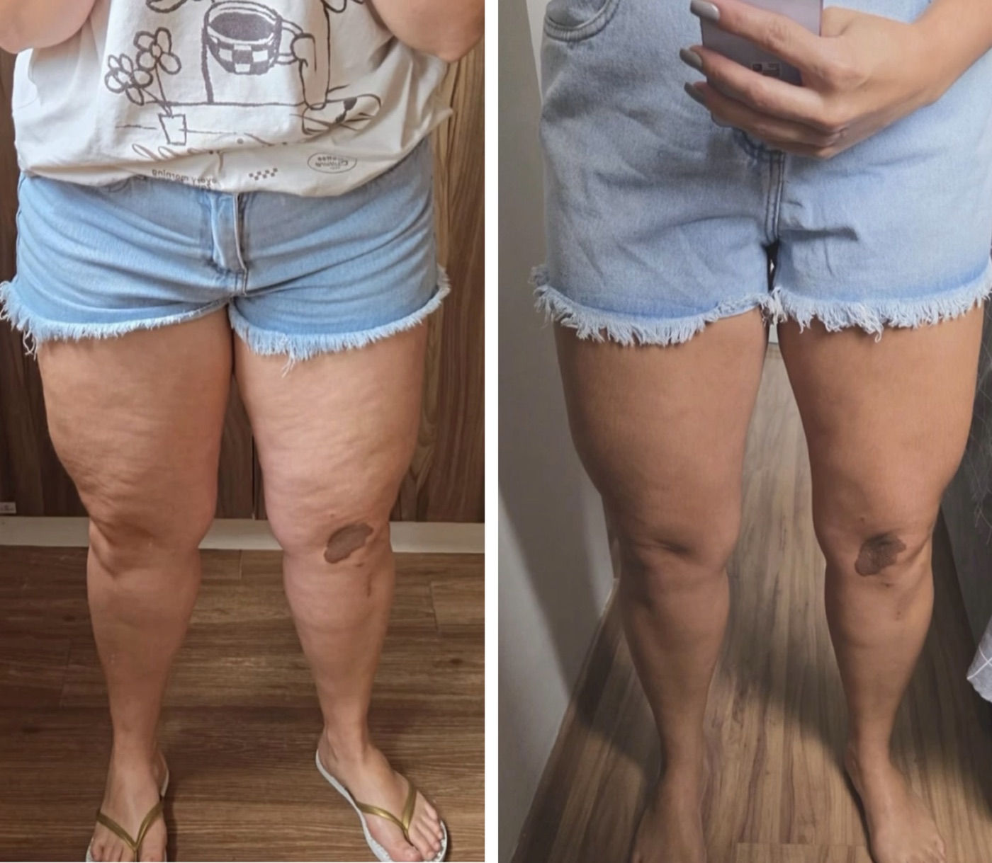 Antes e depois — Tratamento de Lipedema — Dr. Alexandre Dell'Aquila